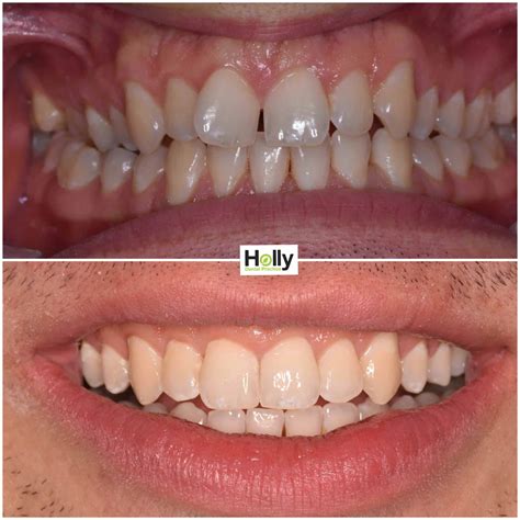 problems with invisalign results.